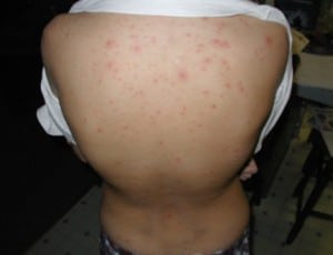 FreshandClean: Infection Prevention and Control - Chickenpox